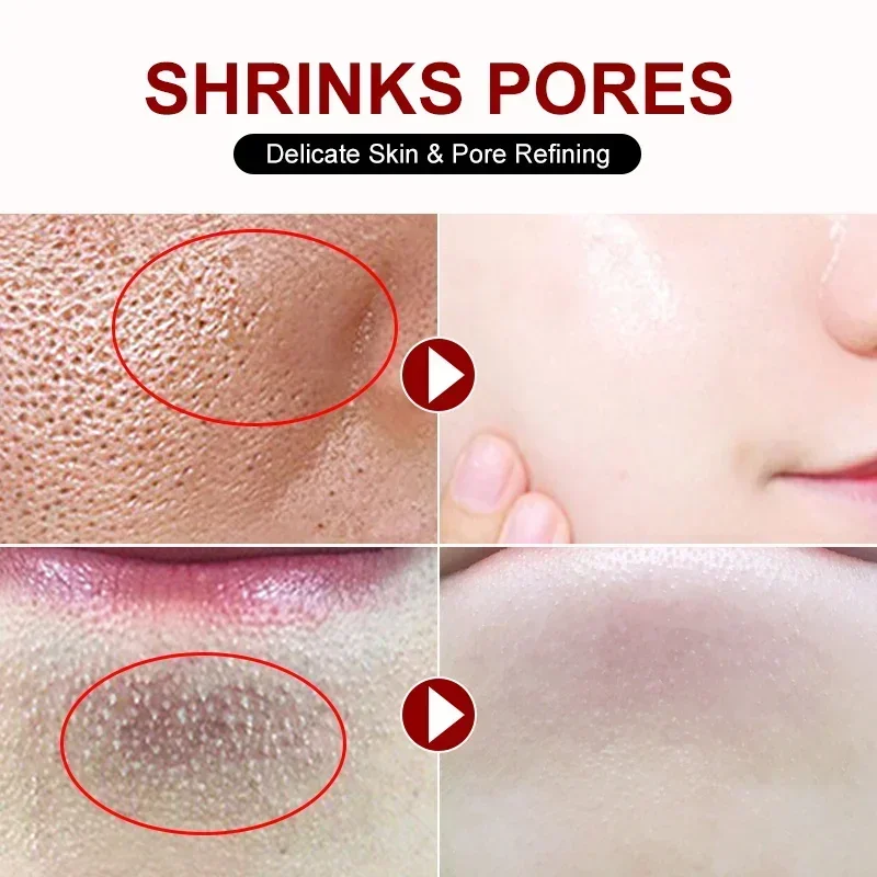 Salicylic Acid Pore Shrinking  - Skincare Salicylic Acid recension och pris